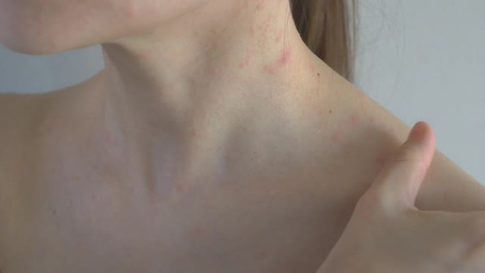在女人的裸露身体上，皮疹形式的病理元素。将皮疹刷在肩膀和胸部区域。过敏性皮炎。特写