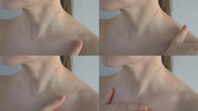 在女人的裸露身体上，皮疹形式的病理元素。将皮疹刷在肩膀和胸部区域。过敏性皮炎。特写