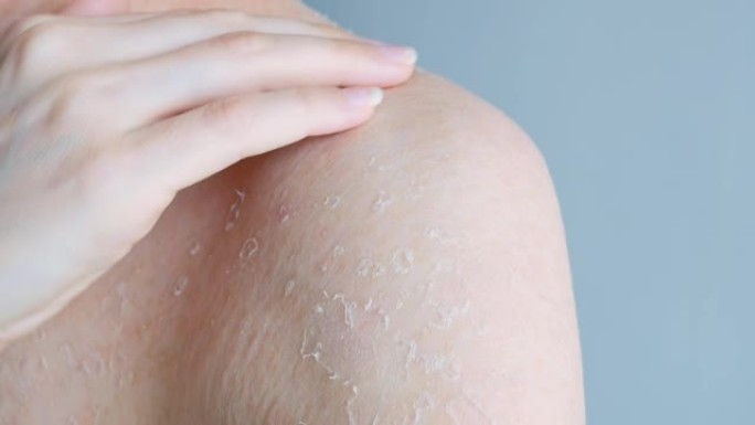 受损皮肤发痒。一名妇女用指甲刮擦皮肤，去除部分皮肤，晒伤后干燥剥皮。皮肤问题。身体护理。特写