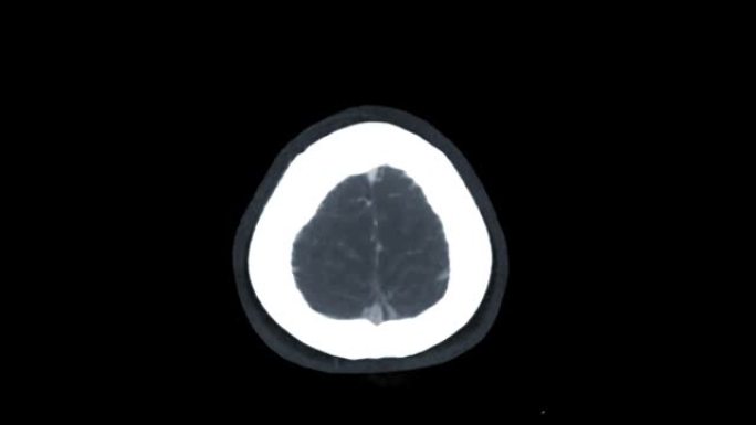 CTA脑或计算机断层扫描血管造影的脑轴向MIP图像。