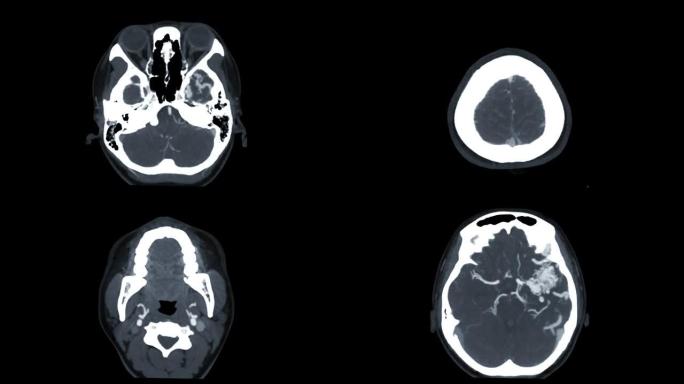 CTA脑或计算机断层扫描血管造影的脑轴向MIP图像。