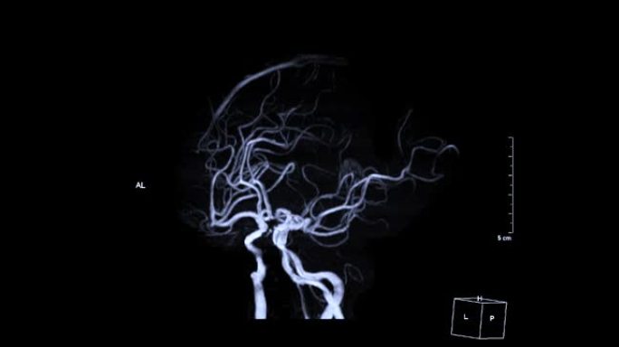 大脑中的血管MRA或磁共振血管造影 (MRA) 在屏幕上转动。MRA脑MIP视图用于评估脑动脉。