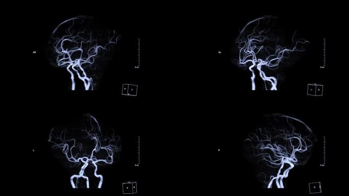 大脑中的血管MRA或磁共振血管造影 (MRA) 在屏幕上转动。MRA脑MIP视图用于评估脑动脉。