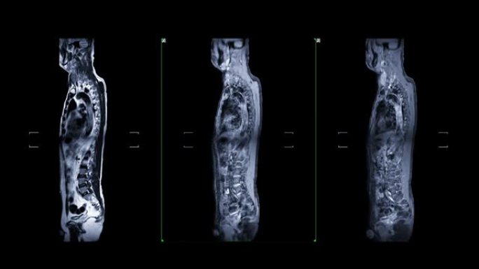 MRI用钆对比筛查整个脊柱，显示脊柱压迫脊髓。