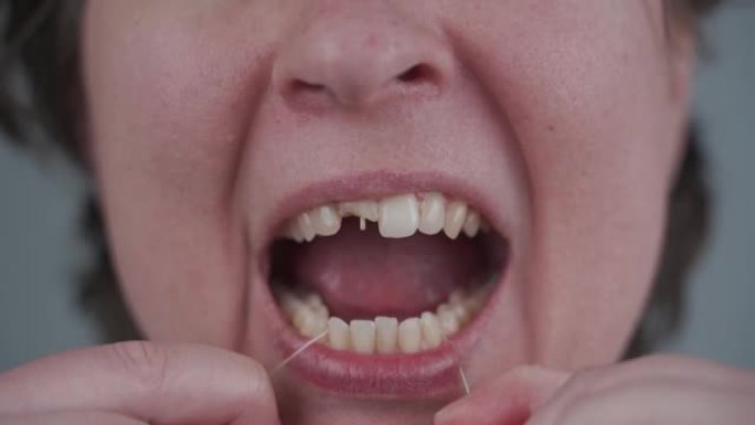 断牙的成年妇女使用牙线。牙齿卫生的重要性。口腔清洁护理主题。健康坏的牙齿。牙科保健。损坏的牙齿。牙科