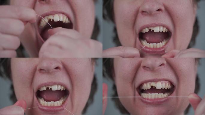 断牙的成年妇女使用牙线。牙齿卫生的重要性。口腔清洁护理主题。健康坏的牙齿。牙科保健。损坏的牙齿。牙科