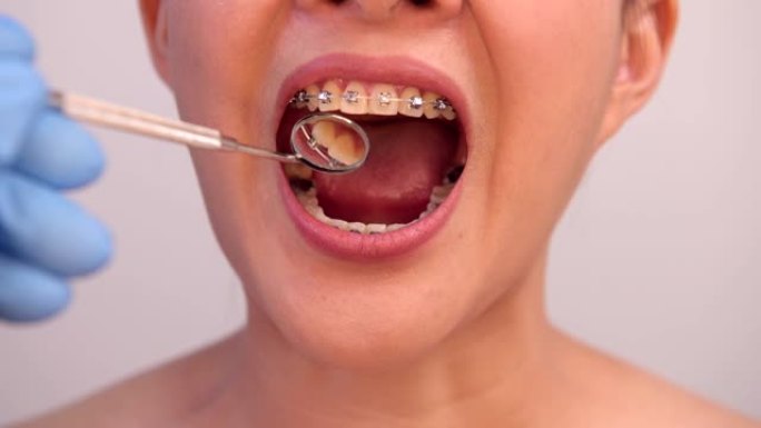 牙医检查戴正畸护圈的妇女。牙科保健和健康牙齿。