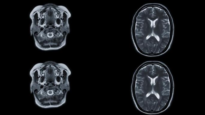 MRI脑轴T2W技术检测中风病。