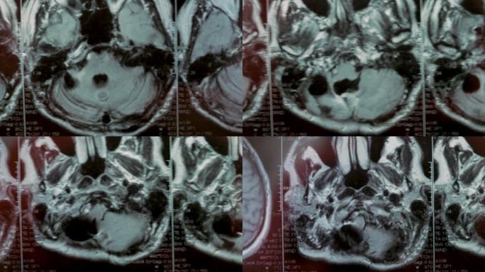 头部MRI扫描。第一人称视角。图为一个大囊肿