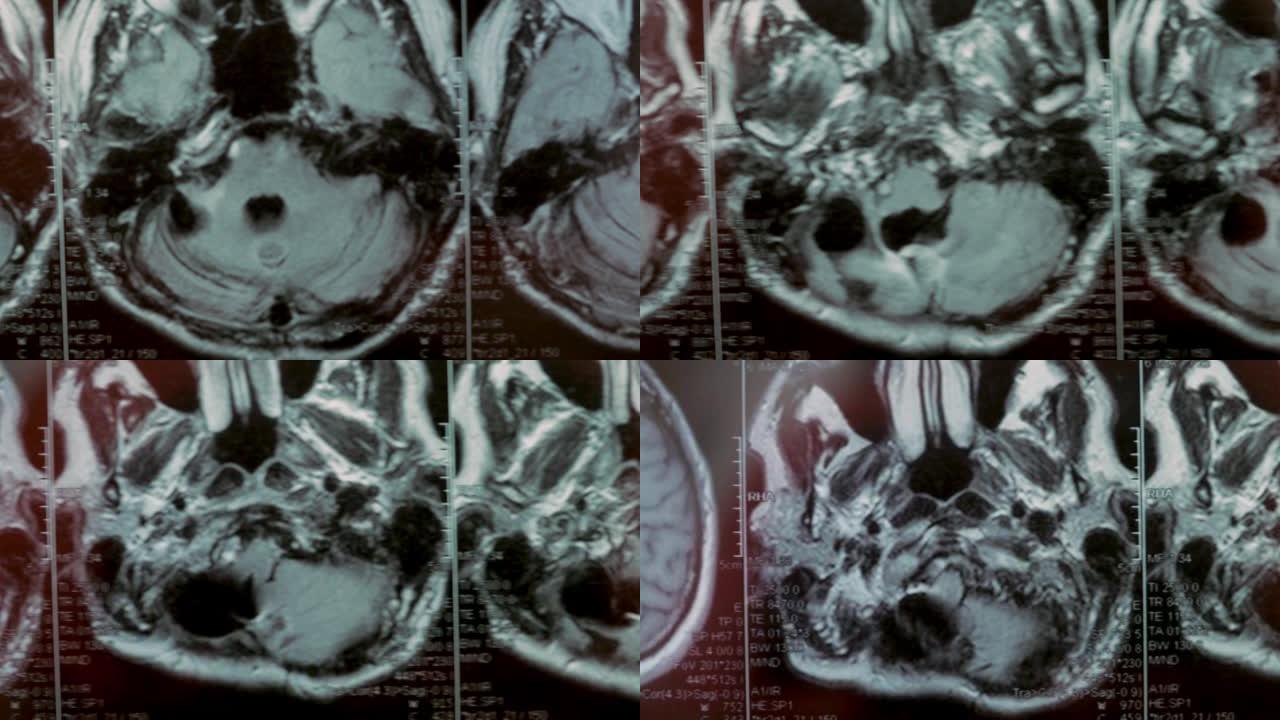 头部MRI扫描。第一人称视角。图为一个大囊肿