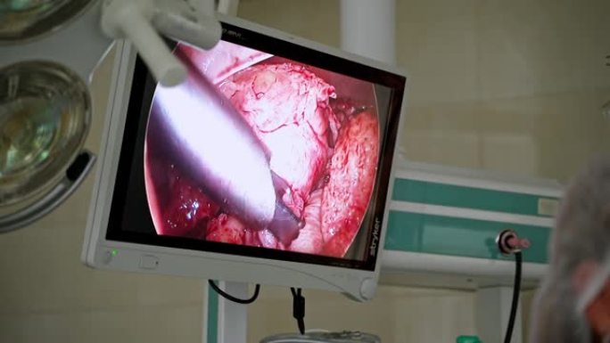 腹腔镜设备手术。使用腹腔镜设备进行妇科手术的过程
