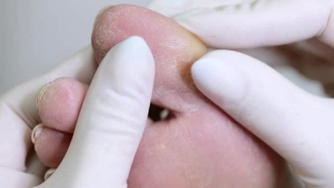 皮肤科医生检查糖尿病患者的脚。有问题的糖尿病足有裂缝和结垢。