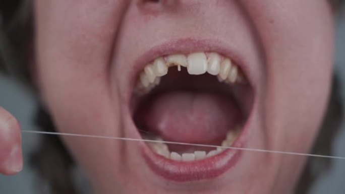 牙线每天清洁和卫生口腔的重要属性。牙齿不好的女人用牙线尝试正确的情况。牙齿折断的女性。牙齿损坏导致卫