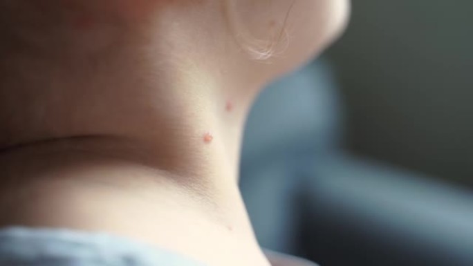 蹒跚学步的女孩身上有水痘麻疹。水痘病毒儿童传染病。发痒的红水泡，发热，疼痛症状。