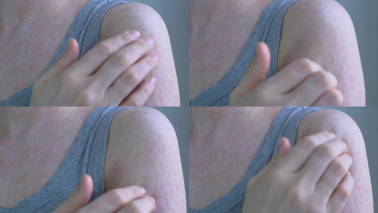 在女人的皮肤表面上，可以看到前臂，特写，凸面，发炎，发红的斑点。斑点轻微划伤。病毒性疾病