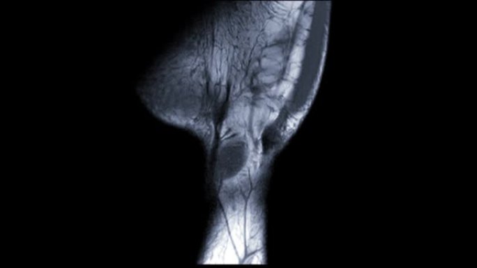 MRI腕关节冠状T1W诊断类风湿关节炎。