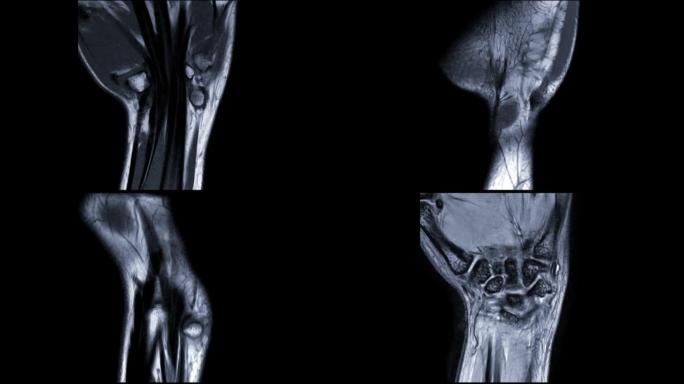 MRI腕关节冠状T1W诊断类风湿关节炎。