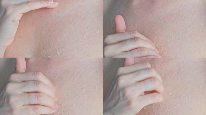 受损皮肤发痒。一名妇女用指甲抓伤皮肤，皮肤被结痂，晒伤后皮肤干燥去角质。皮肤问题。身体护理。特写