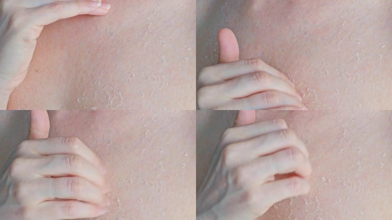 受损皮肤发痒。一名妇女用指甲抓伤皮肤，皮肤被结痂，晒伤后皮肤干燥去角质。皮肤问题。身体护理。特写