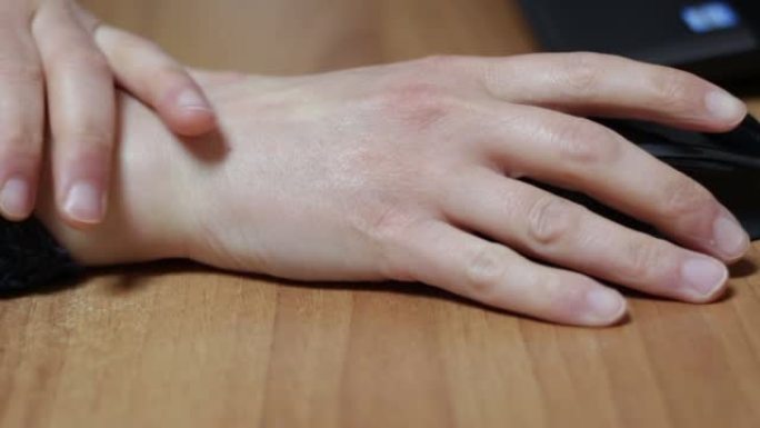 大量使用计算机鼠标引起的成年女性手腕肌腱炎。