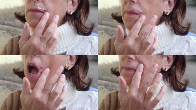 嘴唇上的疱疹，女人脸部的一部分，手指在嘴唇上的疱疹，美容概念