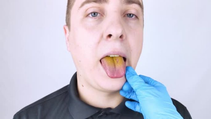 这个人的舌头是黄色的。舌头粘膜上有疼痛的黄色涂层。胃肠道、肝脏和胆囊疾病。服用抗生素的后果。