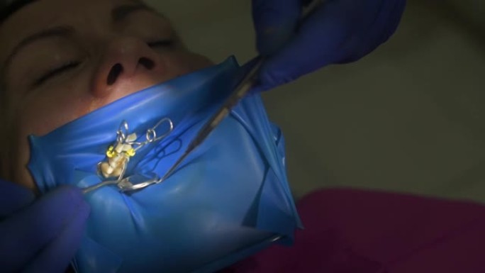 牙医在医疗手套与紫外线装置在他的手与病人工作，硬化填充在牙齿。