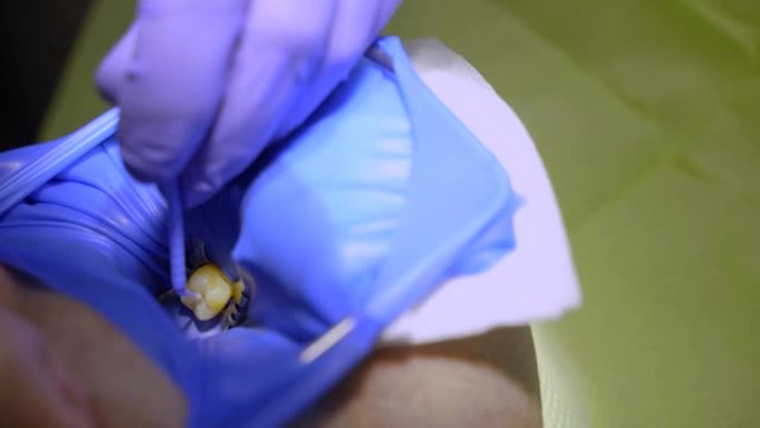 口腔医学中的牙科治疗围堰。牙医使用牙坝进行牙齿隔离。
