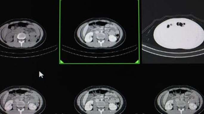 黄体破裂患者腹部的CT全扫描。