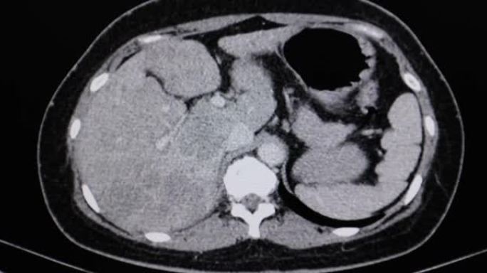 显示肝细胞癌的患者的肝脏ct扫描。