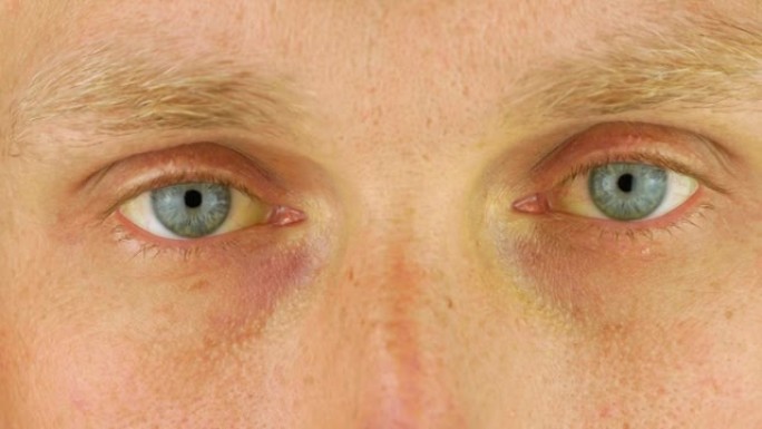 男性眼睛阻塞性黄疸淡黄色。真正的人肝功能异常的肝炎伴肝硬化性肝炎症状面部皮肤。年轻人胆红素色素沉着胆
