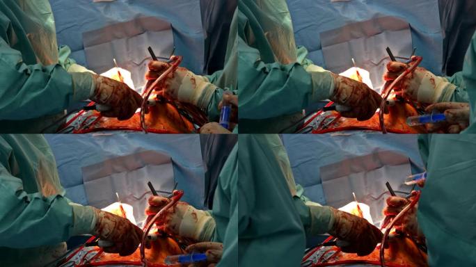 特写心脏外科医生手术心脏手术介入特写替换瓣膜开放脐带手术微创手术