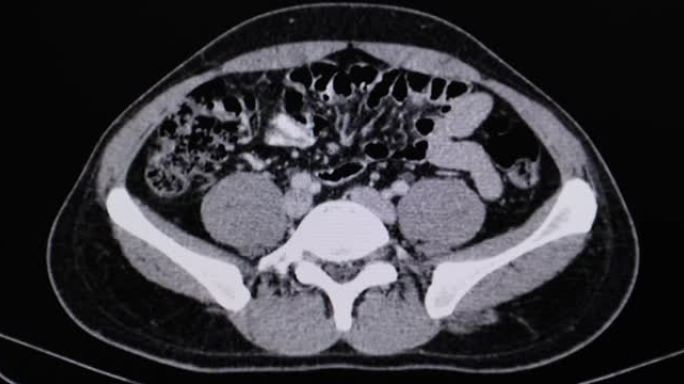 CA睾丸患者的CT腹部电影扫描