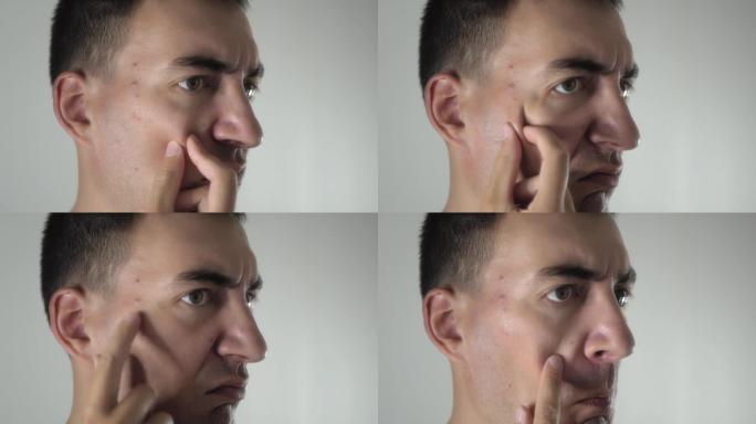 担心的成年男子照镜子，检查脸上的痤疮和痤疮