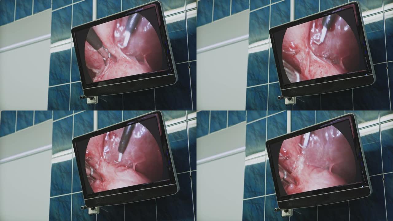 使用腹腔镜设备进行手术