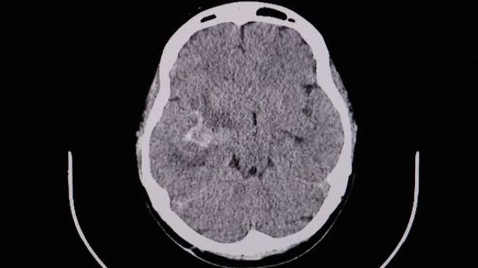 CT脑a患者右基底节区出血和血肿