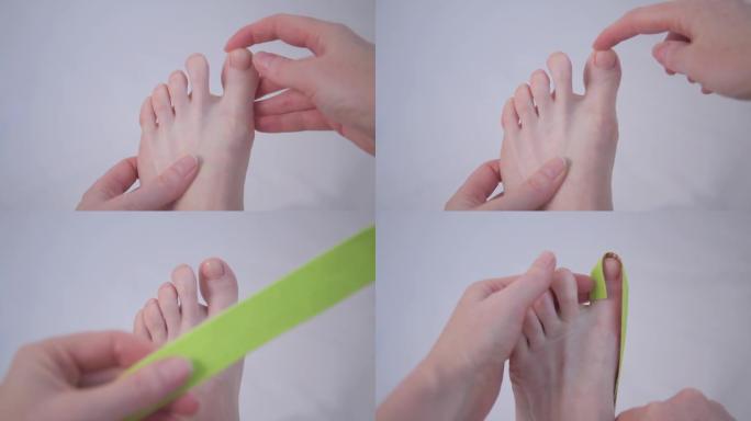 大脚趾畸形。平足。使用kinesio胶带校正手指的位置