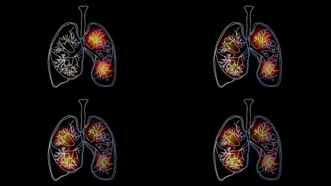 人肺。冠状病毒病毒肺损伤19。技术概念，人类肺的动画。4K