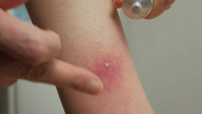 女人腿上被昆虫咬伤的脓肿特写。一个女人治疗伤口。