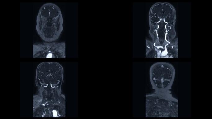 对比MRA脑或磁共振血管造影的脑冠状MIP视图显示脑动脉和颈总动脉。