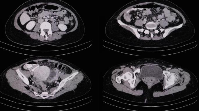输卵管脓肿患者的CT can。
