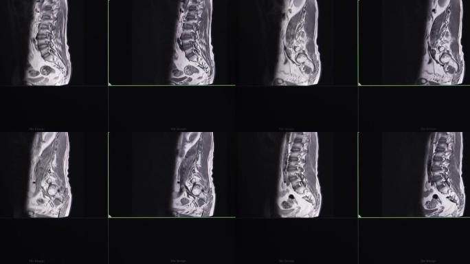腰骶棘的MRI扫描。