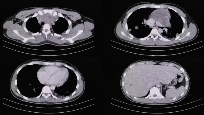 淋巴瘤患者胸部和腹部的CT电影扫描。