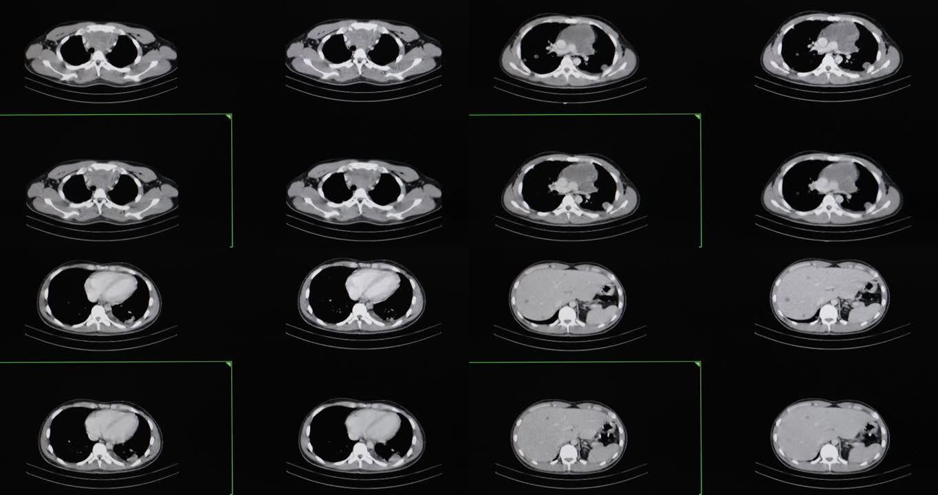 淋巴瘤患者胸部和腹部的CT电影扫描。