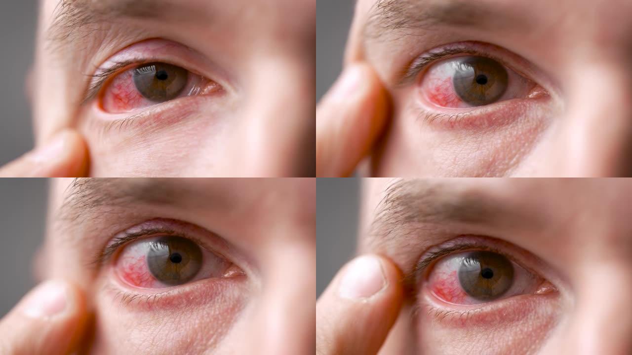 一个眼睛红肿的男人。疾病期间的感染击中了眼睛