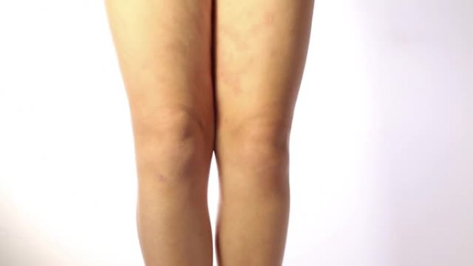 儿童腿部严重的特应性湿疹是皮肤的皮肤病。腿部大，红色，发炎，鳞状皮疹。患有严重特应性皮炎的青少年的腿