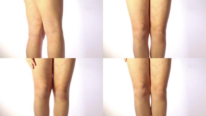 儿童腿部严重的特应性湿疹是皮肤的皮肤病。腿部大，红色，发炎，鳞状皮疹。患有严重特应性皮炎的青少年的腿