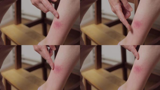 女人腿上被昆虫咬伤的脓肿特写。一个女人治疗伤口。