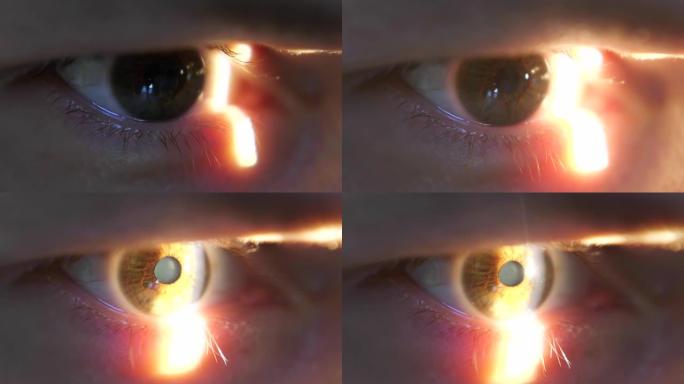 在眼科诊所用裂隙灯进行眼科检查时，用激光束照射的患者眼睛的特写镜头。