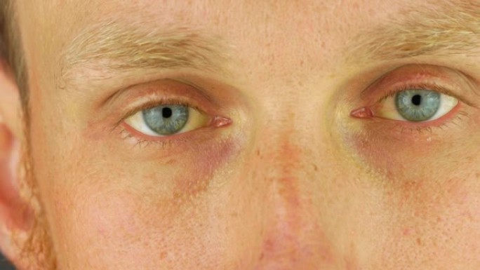 男性眼睛阻塞性黄疸淡黄色。真人肝功能异常黄疸伴肝硬化肝炎症状面部皮肤。年轻人胆红素色素沉着胆道梗阻吉